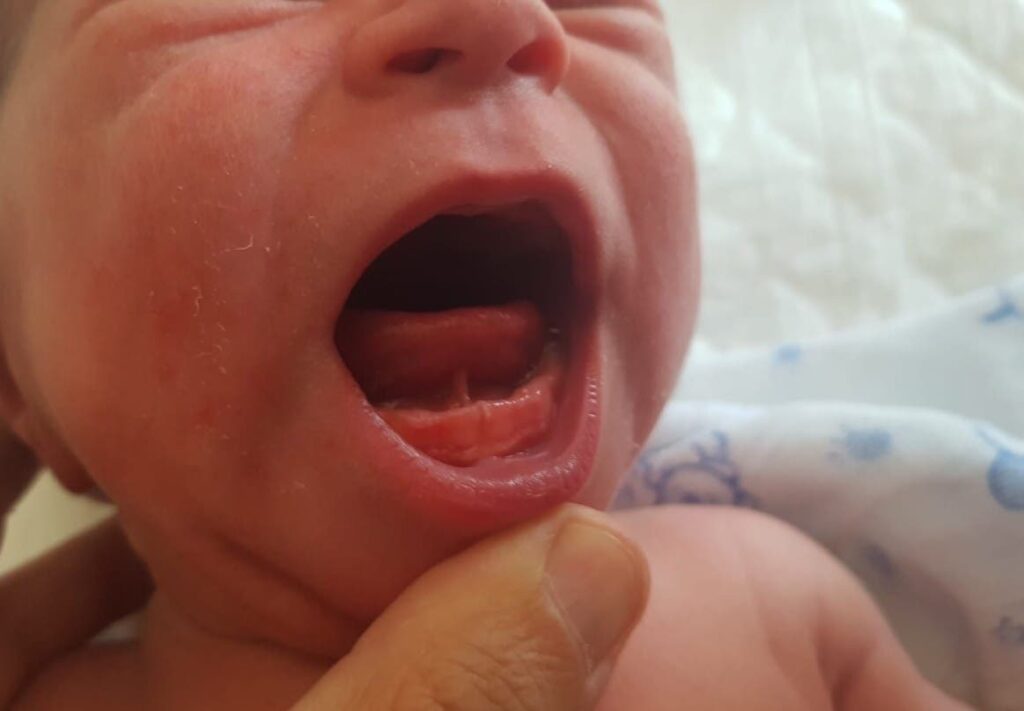 anquiloglosia lengua anclada frenillo