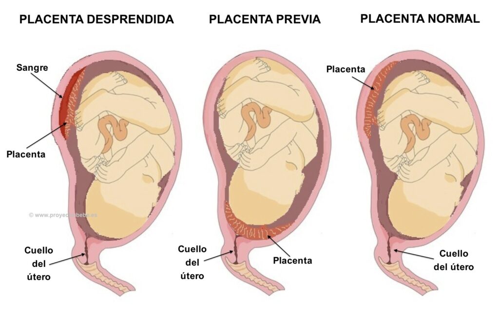 desprendimiento placenta